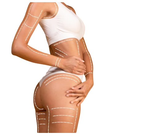 lipoescultura precio